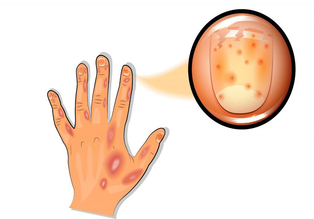 увреждане на ноктите при псориазис