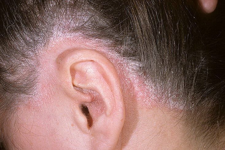 Обриви на псориазис на главата зад ушите