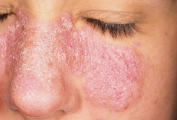 Прогресивен стадий на псориазис по кожата на лицето
