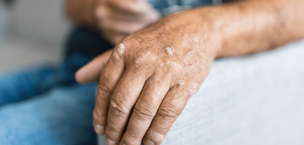 Псориазис по кожата на ръцете