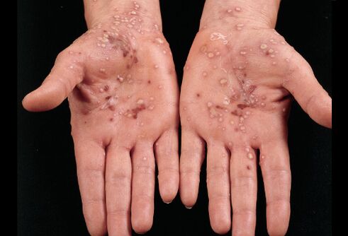 как изглежда псориазисът по дланите на ръцете