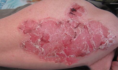 как изглежда пустулозният псориазис върху кожата
