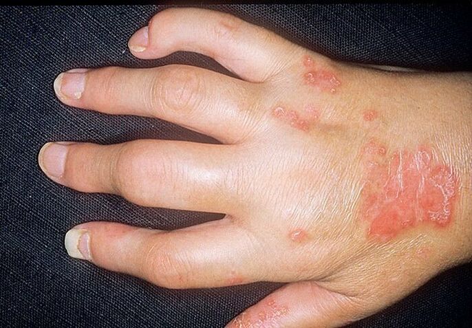 псориатичен артрит на ръцете