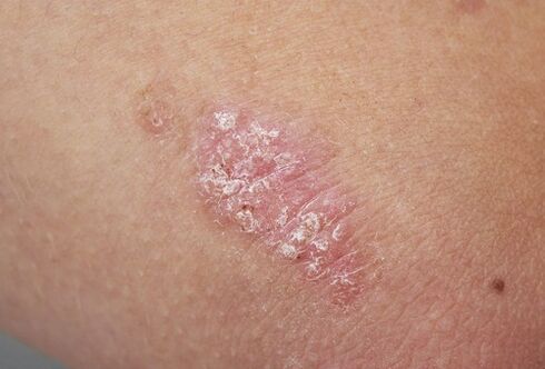 псориатична плака по кожата