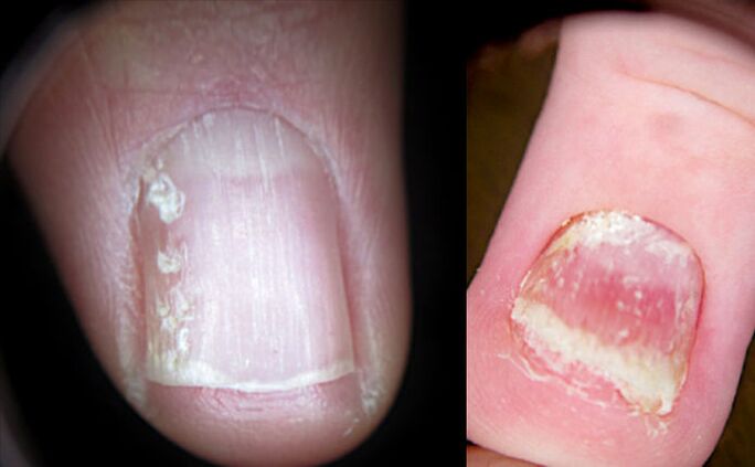 Натрошени нокти с псориазис