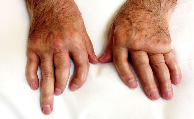Осакатяващ артрит при псориазис