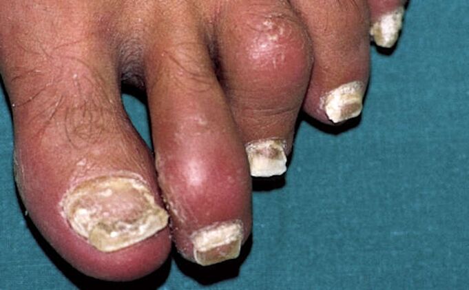 Псориазис със засягане на ноктите и възпаление на ставите (артрит) на пръстите на краката
