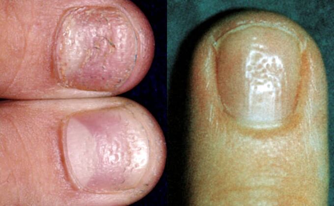 Симптом на напръстника - множество вдлъбнатини по повърхността на нокътната плоча