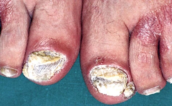 Тежка субунгвална хиперкератоза и псориатични плаки по пръстите на краката