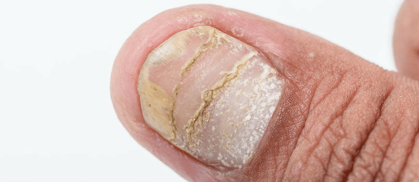 остра форма на усложнения на псориазис на нокътя